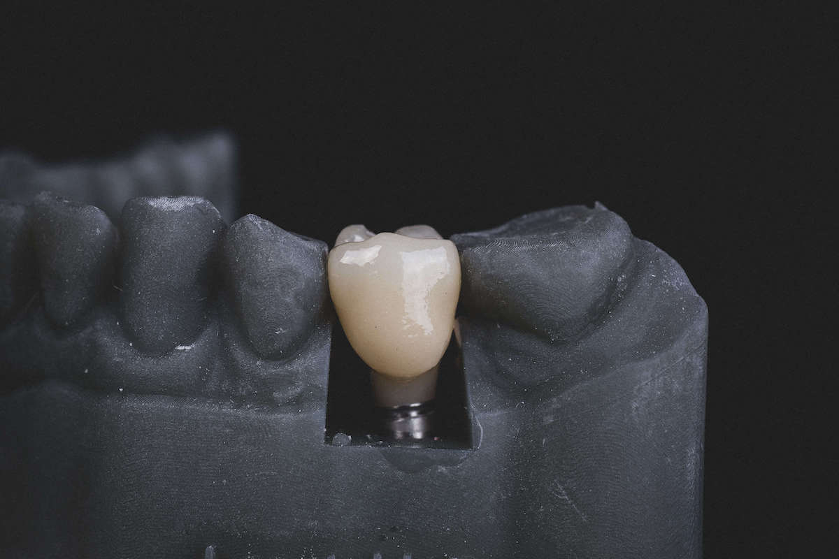 Implanty zębów Wrocław
