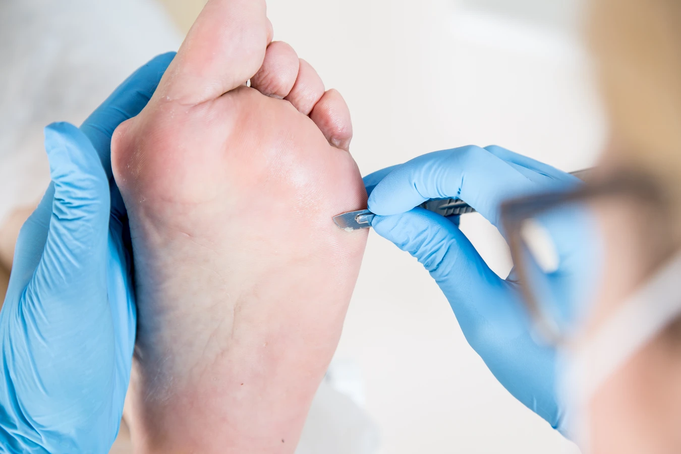 Kurzajki na stopach - nie lekceważ problemu